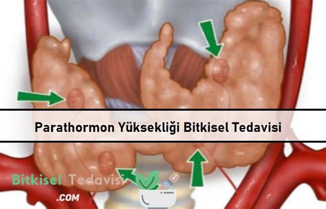 Parathormon Bitkisel Tedavi Yöntemleri Bitkisel Tedavi