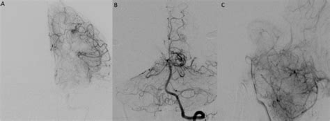 Stereotactic Radiosurgery For Brain Arteriovenous Malformations In Patients With Hereditary