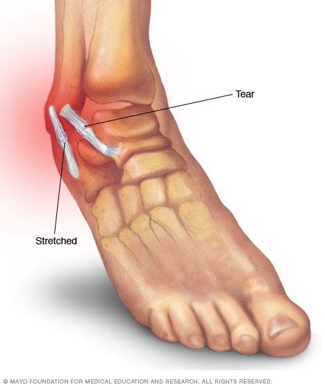 Illustration Showing A Sprained Ankle Sprained Ankle Tendinitis