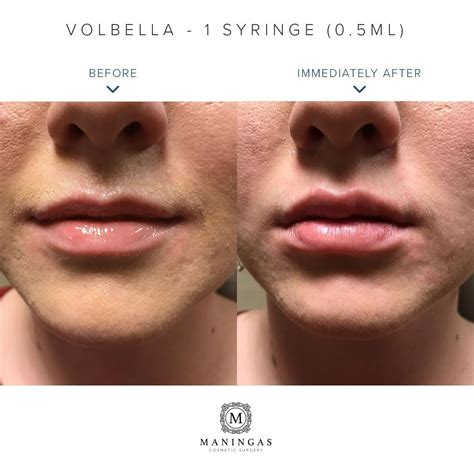 Lip Filler Before And After Natural Before And After