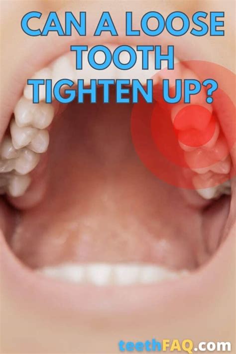 Will A Loose Tooth Tighten Back Up Teeth Faq Blog