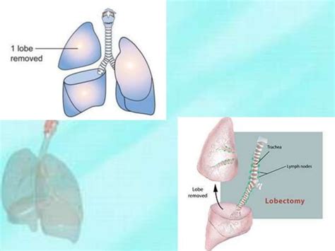 Lung cancer surgery | PPT