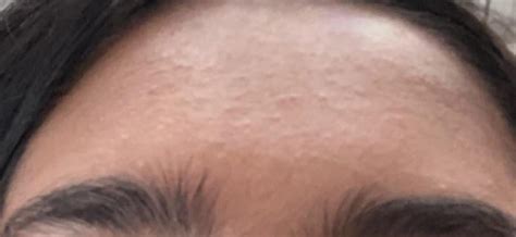 How Do I Get Rid Of This Texturebumps On My Forehead Not Sure About