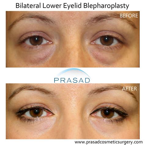 Under Eye Bag Surgery Prasad Cosmetic Surgery New York