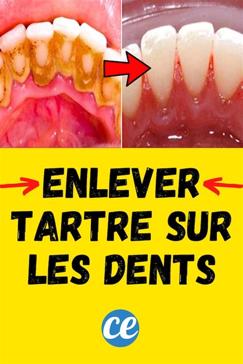 Mes Astuces Pour Enlever Le Tartre Dentaire Soi M Me