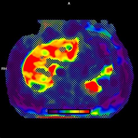 Mr Elastography Maryland Radiologist Charter Radiology