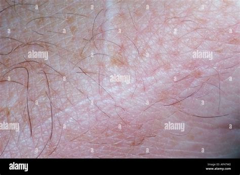 Vitiligo : Koebner phenomenon Stock Photo - Alamy