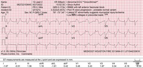 Hyperkalemia Ecg Stampede