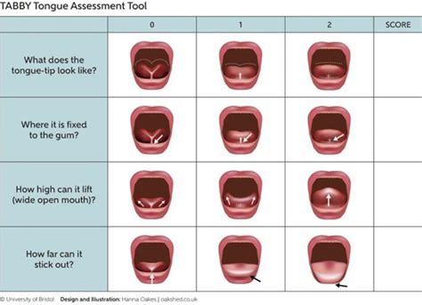 Tongue Tie Ankyloglossia