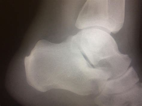 Haglunds Deformity Rradiology