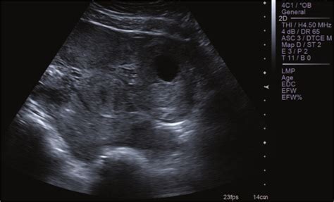 Ruptured Ectopic Pregnancy Ultrasound