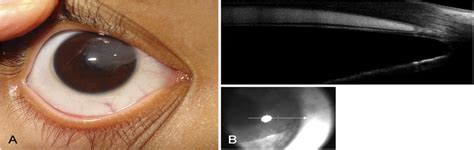 Surgical Treatment Of A Corneal Epithelial Cyst Cornea