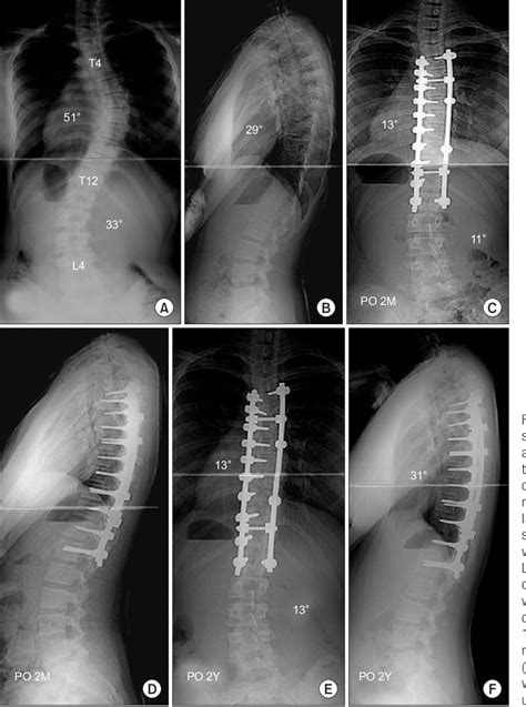 Figure 1 From Correction Of Single Thoracic Adolescent Idiopathic Scoliosis Using Pedicle Screw