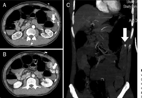 [pdf] [a Case Of Dieulafoy Lesion Of The Jejunum Presented With Massive Hemorrhage] Semantic