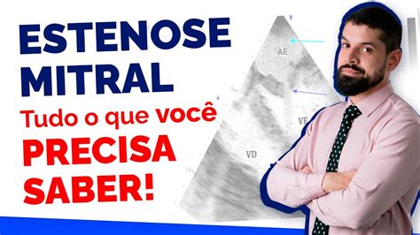 Estenose Mitral Tudo O Que Voc Precisa Saber Causas E Tratamento