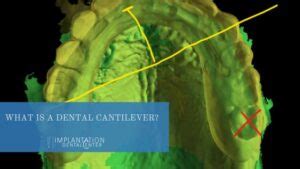 cantilever bridge · Implantation Dental Center