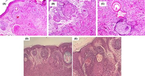 A Case Of Retro‐auricular Panfolliculoma Mimicking Basal Cell Carcinoma