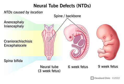 Neural Tube Defects Ntds What They Are Causes Off