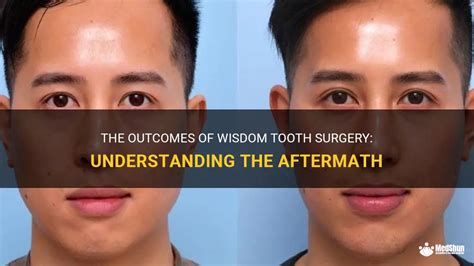 The Outcomes Of Wisdom Tooth Surgery Understanding The Aftermath Medshun