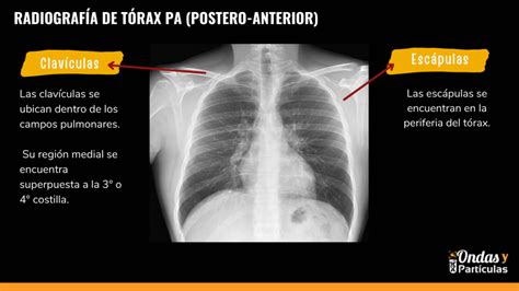 Radiografia De Torax Pa Image To U