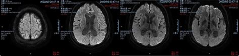 Case Report Sacral Neuromodulation For Neurogenic Lower Urinary Tract Dysfunction In Patient