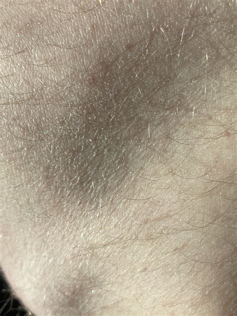 WHY DOES MY SKIN LOOK LIKE THIS? AND WHEN I SCRATCH FLAKES GO FLYING