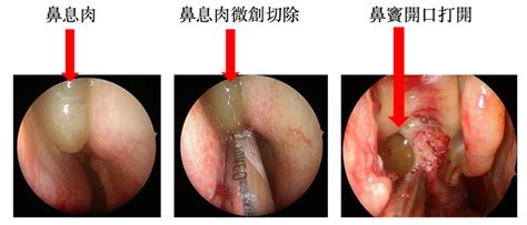 擺脫復發性鼻竇炎 3d立體定位導航navigation微創手術快狠準 中山醫訊