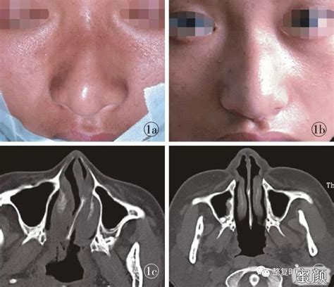 歪鼻合并鼻中隔偏曲同期整复治疗 蜜颜优惠