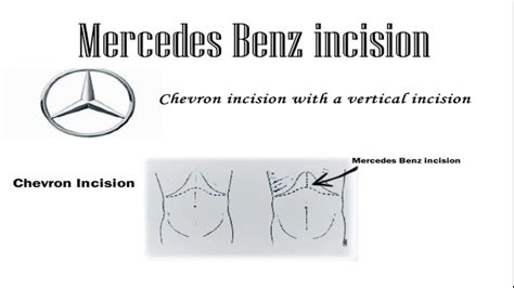 Chevron And Mercedes Benz Incision Youtube