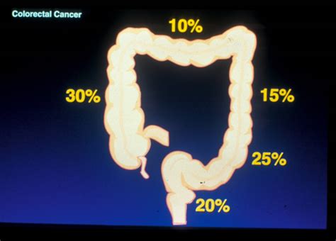 Gi 39 Colon Cancer Flashcards Quizlet