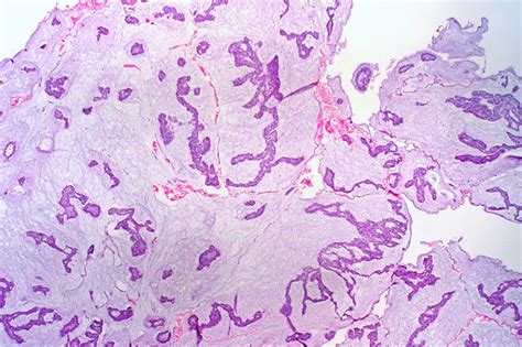 Mucinous Carcinoma Of The Breast Cancer Guide 2