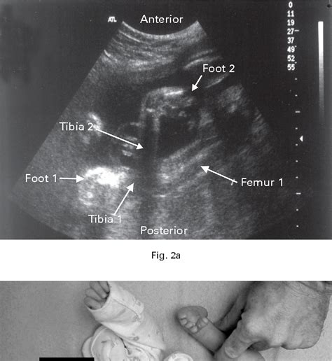 Pdf Prenatal Ultrasound Diagnosis Of Club Foot Outcome And