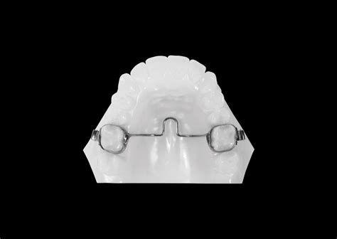 Transpalatal Arch Appliance Universal Orthodontic Lab