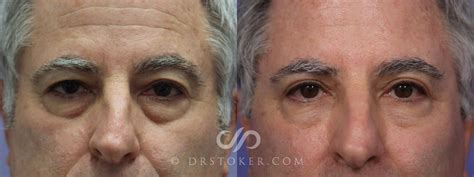 Eyelid Surgery Before And After Men