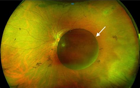 Pigmented Iris Cyst In Vitreous Chamber Bmj Case Reports