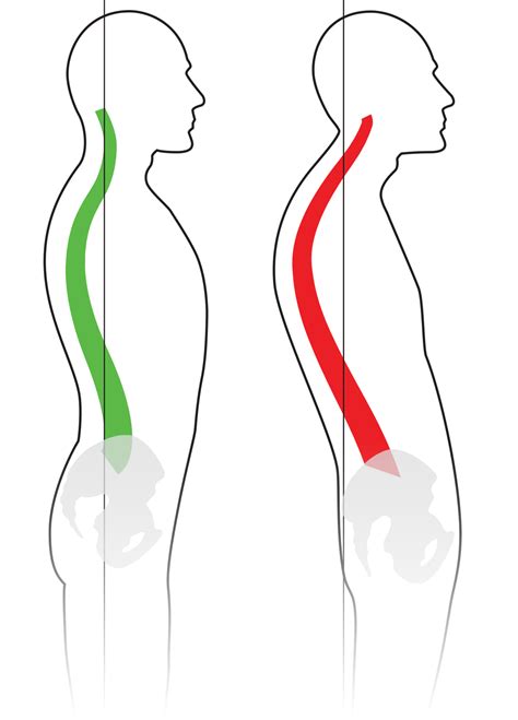 Spinal column - Kyphosis - Thoracic kyphosis - Spinal deformity