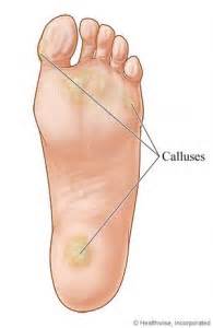 Best Way To Remove Calluses From Feet Callus Guide