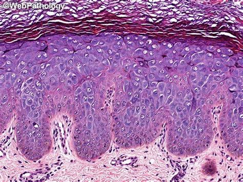 Epidermodysplasia Verruciformis