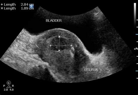 Uterine Fibroids Ultrasound