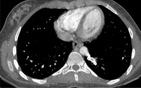 Figure 1 From Transcatheter Embolization Of A Large Aberrant Systemic