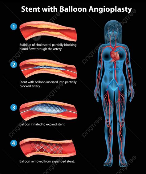 Stent Angioplasty Procedure Blood Sclerosis Blockage Vector Blood