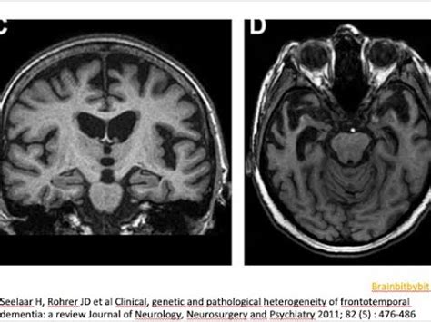 Frontotemporal Dementia On Mri Ftld Neurodegenerative Tau