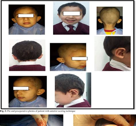 Figure 3 From Comparative Study Between Anterior And Posterior Scoring