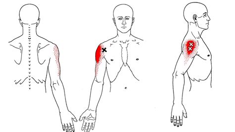 Axillary nerve palsy Injury - Injury Choices