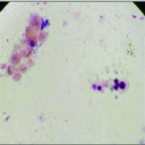 Grams Positive Budding Yeast Like Structures Seen In Grams Stain Of