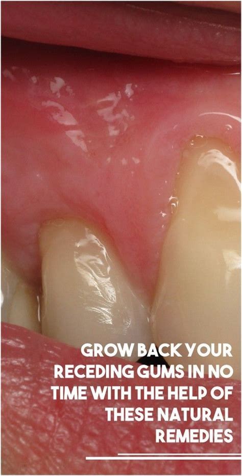 Grow Back Your Receding Gums In No Time With The Help Of These Natural