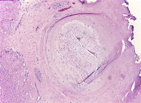 Pathology Outlines Chronic Allograft Vasculopathy