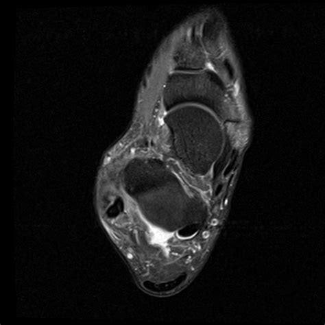 Accessory Navicular Syndrome Image