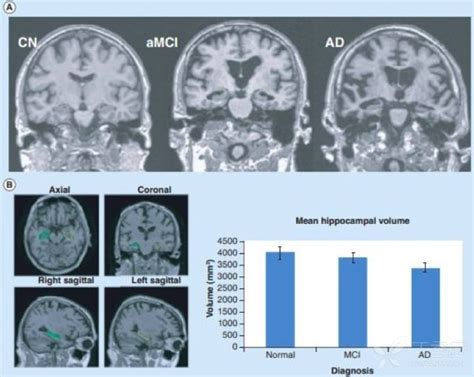 早期诊断阿尔茨海默病的7大影像标记物，值得收藏！ 丁香园