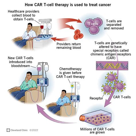 CAR T Cell Therapy For Multiple Myeloma Patients In Europe Israeli